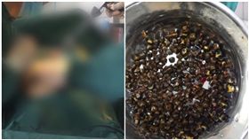 100公斤男取出504顆膽結石（圖/翻攝自梨視頻）