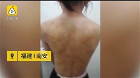 後母,繼母,毒打,滾水燙,女童,傷痕(翻攝自梨視頻)