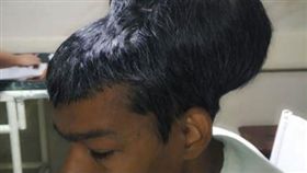 世界最大腦瘤。（圖／翻攝自推特）