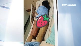 蜜桃臀整不成！美魔女「玉腿變火腿」