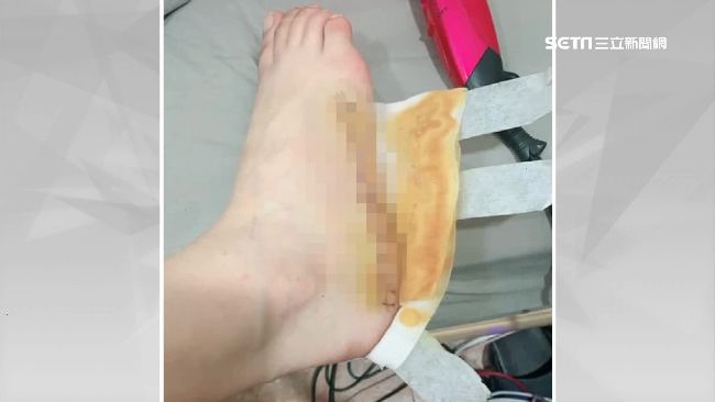 好痛！櫃姐控遭彈簧床割傷腳縫18針