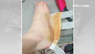 好痛！櫃姐控遭彈簧床割傷腳縫18針