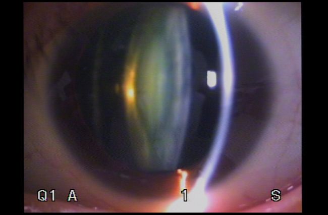 一名30多歲科技業男子因長期日夜顛倒、三餐依賴外送炸物與手搖飲，某天在上班時突然昏倒。送醫檢查後發現血糖竟飆到800多，進一步檢查更讓醫師冒出一身冷汗，因為他的眼球血管早已破裂。（示意圖／資料照）
