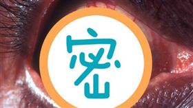 急性青光眼發作