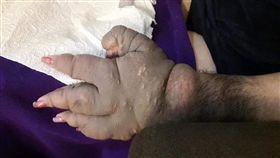 朋友中降頭慘變「鱷魚手」。（圖／翻攝自爆怨公社）