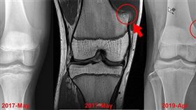花蓮少年長「骨軟骨瘤」…打球受傷回診　醫驚呆：腫瘤沒了
圖翻攝自基督教門諾會醫院官網