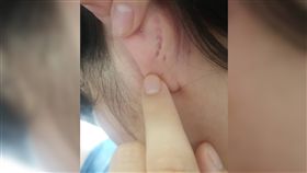 耳朵,凹洞,瘻管,齒痕,粉刺（圖／翻攝自爆系知識家）