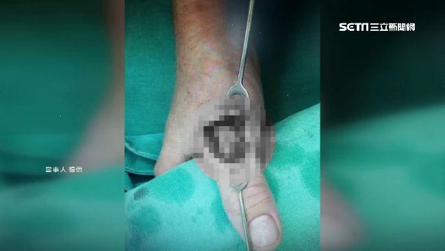 遭切肉機斷肌腱　單親媽控雇主不給薪