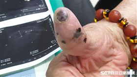 91歲施姓阿嬤右大拇指存在30年的「痣」發生癌變。（圖／彰化醫院提供）