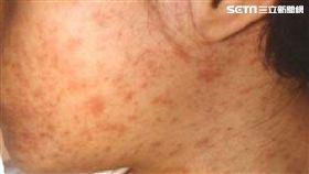 麻疹
圖／翻攝自台中市政府官網
https://www.taichung.gov.tw/8868/8872/9962/867938/post