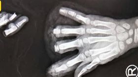 8歲留守妹在家玩！手指被「豆製品機器」啪啪切下...斷了4根。（圖／翻攝自梨視頻）