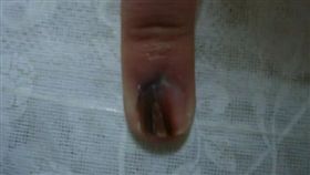 她指甲1條黑線多年不消　一檢查要「切掉手指」才能保命(圖/翻攝自微博)
