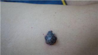 黑痣癌變超致命　五大警訊一定要知道