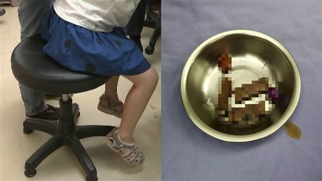 女童下體流咖啡色分泌物　醫一挖驚呆