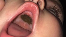 女兒張嘴驚見「詭異黑斑」…媽嚇歪送醫　結果被3萬人笑死
圖翻攝自Darian Depreta臉書