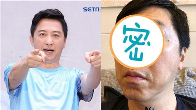 近照曝光！庾澄慶「大出血」眼白消失