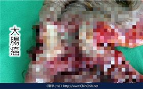 大腸癌（圖／翻攝自Care照護線上）