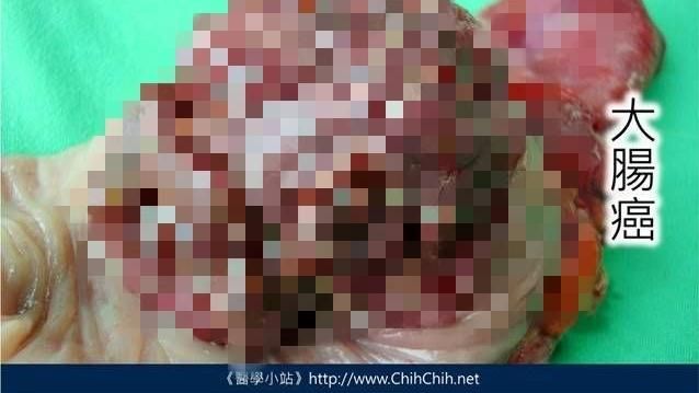 慎入！醫曝數張「腸癌」恐怖真面貌…