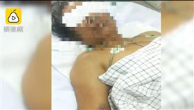 草藥,向天果, 黃疸,肝損害,肝衰竭(翻攝自梨視頻)