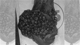 膽結石（圖/翻攝自Meddy Bear臉書）