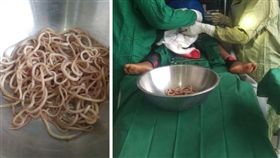 西非喀麥隆男童腸裡有滿滿蛔蟲。(圖/翻攝自《醫學案例報告期刊》）