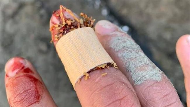 工地受傷血狂流！老師傅教用菸草止血