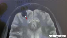 箭頭所指的位置即為腫瘤呈現鐘乳石狀往腦內生長。（圖／童綜合醫院）