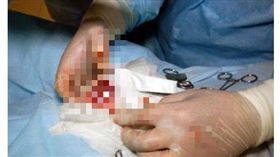 13歲男童蛋疼就醫　全身檢查完發現「少一顆臼齒」竟從子孫袋夾出！(圖/翻攝自太陽報)