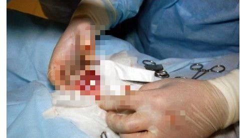 男童下體痛…醫從睪丸內夾出消失臼齒