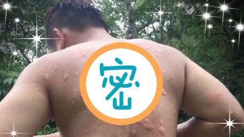 男遭小黑蚊狂咬　網嚇：快壓十字架