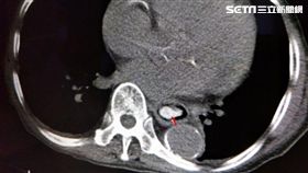 9旬爺吃完榴槤不舒服　就醫電腦斷層掃描...食道竟卡榴槤籽／台中童綜合醫院提供