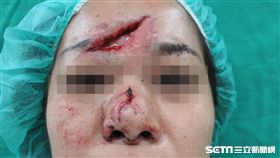 40歲患者許小姐不慎從樓梯上跌下，造成臉部嚴重受傷。（圖／彰化醫院提供）