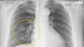 肺癌,彰化醫院,衛福部,痔瘡,衛福部彰化醫院胸腔內科醫師林澤宏