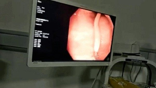 女肚痛十多年！醫抓出「30公分蟲」