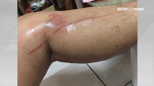 時代在變！　小傷口處理這樣做才正確