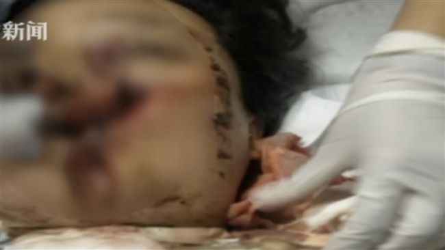 球體撞進玻璃　衰女「臉被砸凹」噴血