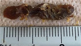 挖出「世界最大耳屎」　醫師也驚呆（圖／翻攝自YouTube）