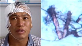 樹枝,跌倒,雲南,併發症,治療,流膿,頭痛,腦,奇蹟　圖／翻攝自梨視頻