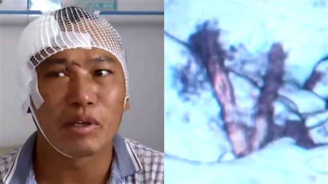 11公分樹枝留腦中　男5年後才就醫