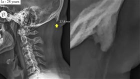 低頭族,手機,骨刺,健康,身體,警訊,危害,滑手機, 圖/翻攝自推特 https://parg.co/RCw