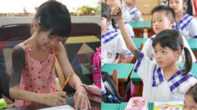  琪琪，黑痣，先天性巨大型黑色素痣