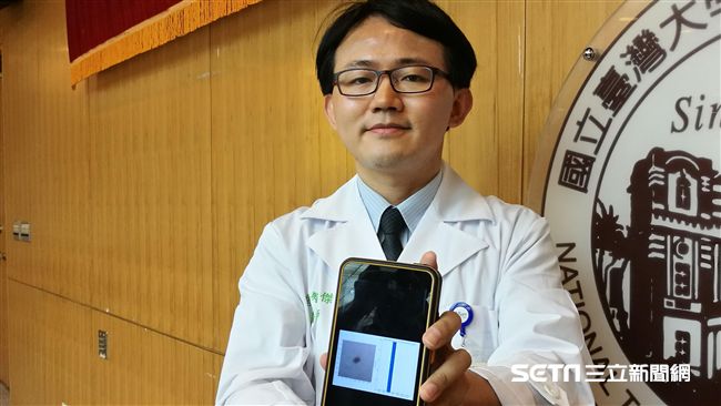 「怪痣」怕是癌？手機拍一張秒知..