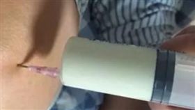 廣東男子每天灌啤酒膝蓋痛風抽出奶狀液體。(圖/翻攝自梨視頻)