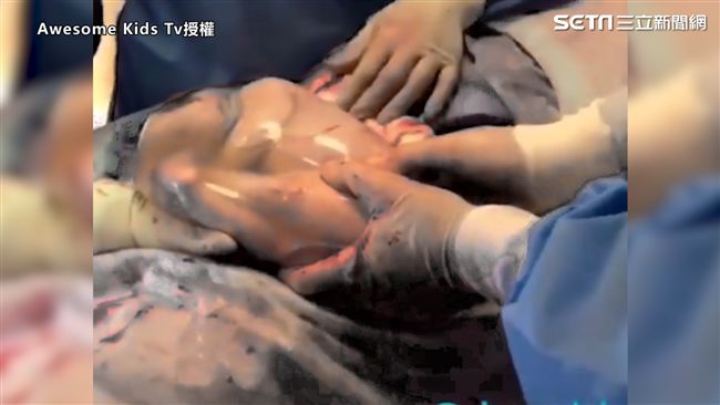 奇蹟寶寶誕生　出生還在「羊膜」裡
