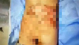  小學生被5同學霸凌燙爛下體　校長：鬧著玩 《春城晚報》