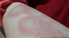 乾癬,傳染,無知,皮膚病,治療(圖/翻攝自爆怨公社)