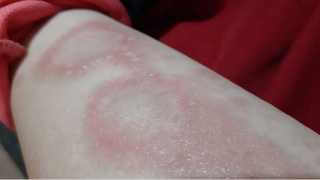 手臂有乾癬！同事竟嘲笑：缺德才會得