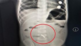 中國江西,磁鐵,腸穿孔 （圖／翻攝自中新網）