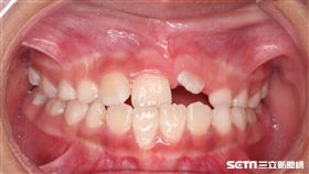 一名9歲伍姓女童露齒笑就缺2顆牙，原來是左上正中門牙與左上犬齒是阻生齒導致。（圖／童綜合醫院提供）