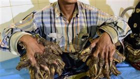 孟加拉,罕見疾病,樹人綜合症,截肢,肉疣(圖/翻攝自YOUTUBE 
PatrynWorldLatestNew)